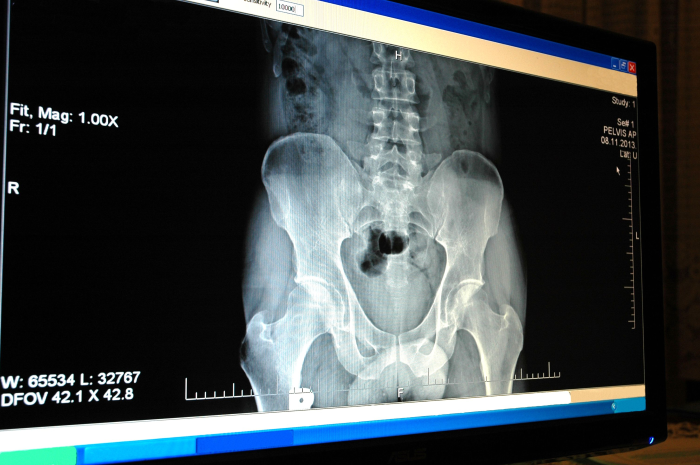 Osteoporosis (áĄáááŻá¸áá˝ááąáŹááŤ)