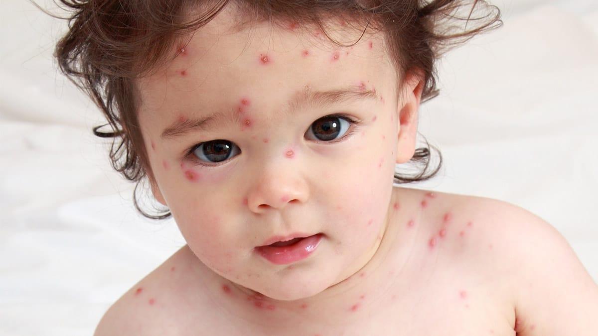 Chickenpox (ရေကျောက် ရောဂါ)