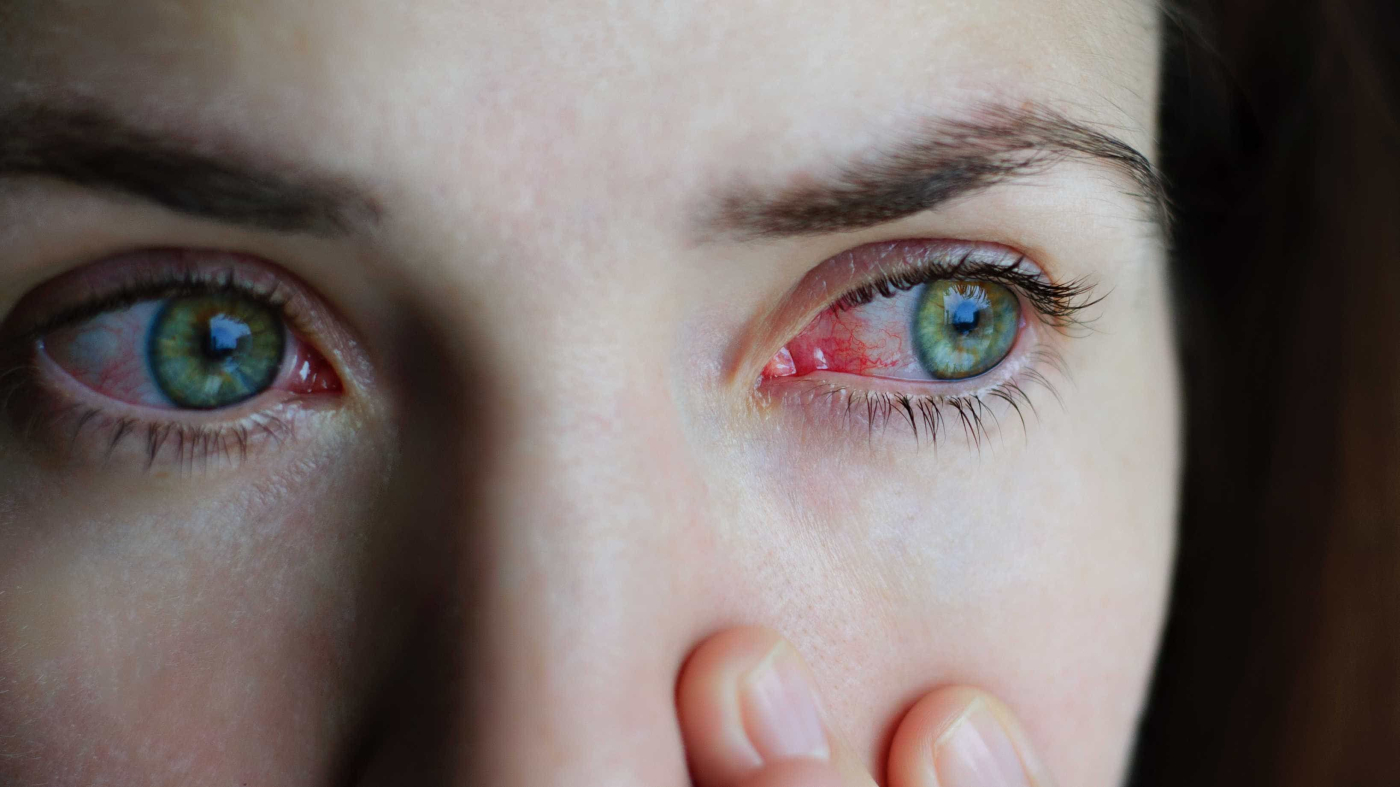 မျက်ခွံအတွင်းသား ရောင်ရမ်းခြင်း ( Conjunctivitis )