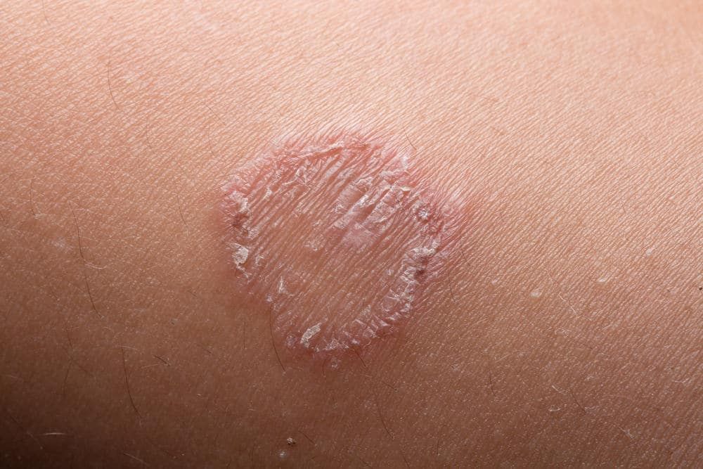 Tinea Infection (ပွေးပေါက်ခြင်း)