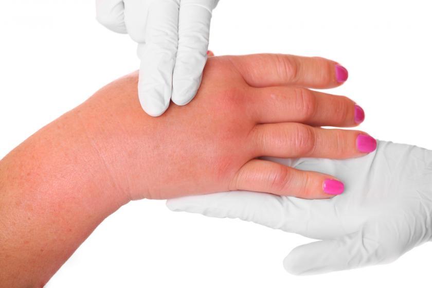 Angioedema (ဓါတ်မတည့်မှုကြောင့် အရေပြားရောင်ရမ်းခြင်း)
