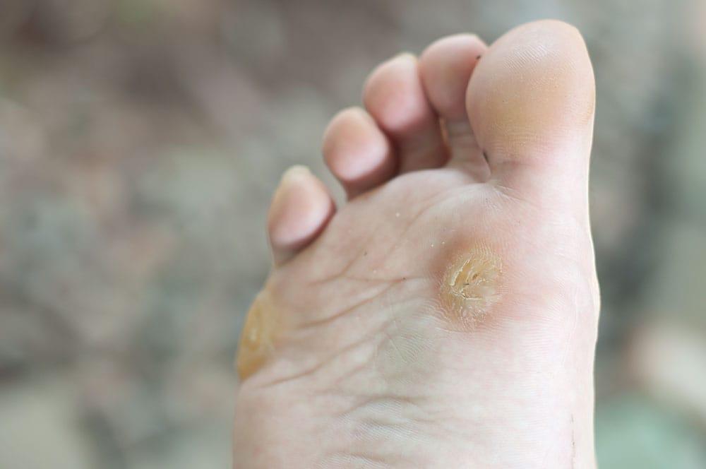 Callous (áĄááŹá¸ááŹááťáŹá¸)