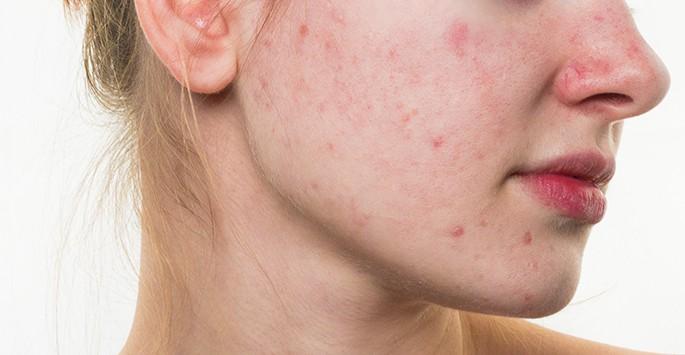 ရိုစေးရှား (Rosacea) အကြောင်းတစေ့တစောင်း