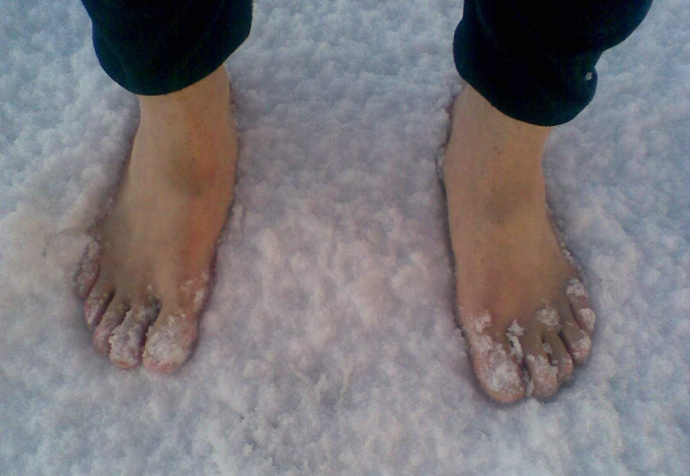နှင်းကိုက်နာ ။ ဘယ်လိုရှာဖွေ၊ကုသ၊ကာကွယ်မလဲ