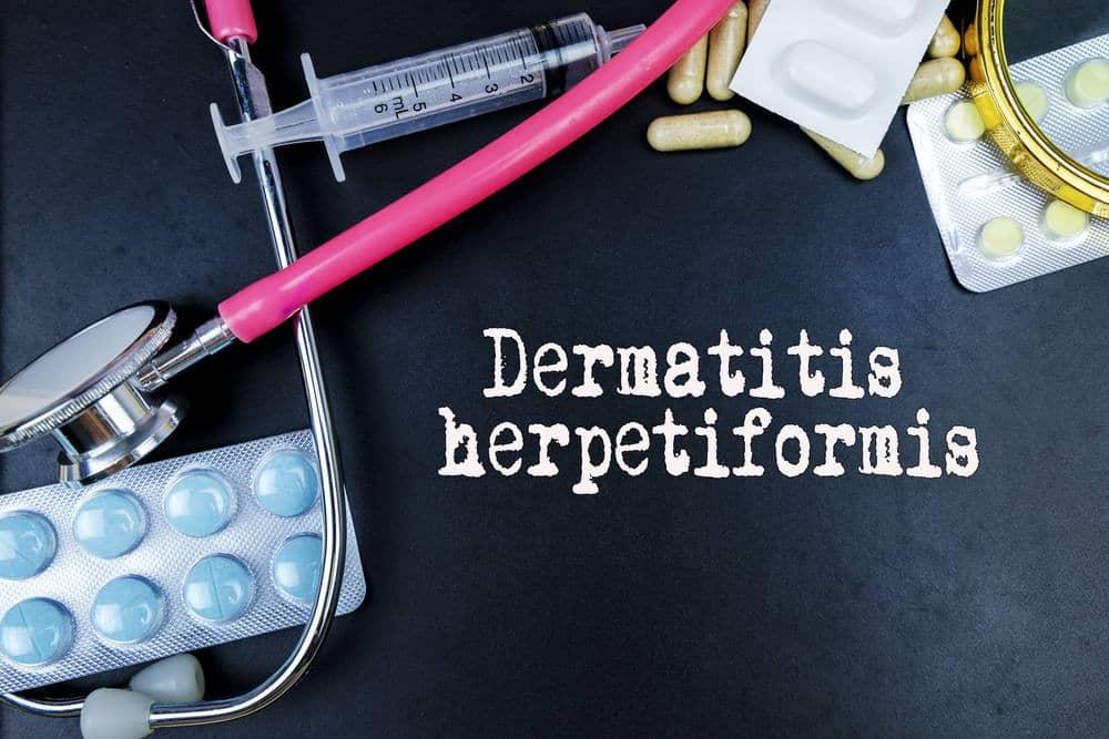 Dermatitis herpetiformis(DH) လို့ခေါ်တဲ့ ယားယံတတ်တဲ့အနီရောင်အရည်ကြည်ဖုလေးတွေပေါက်ခြင်း