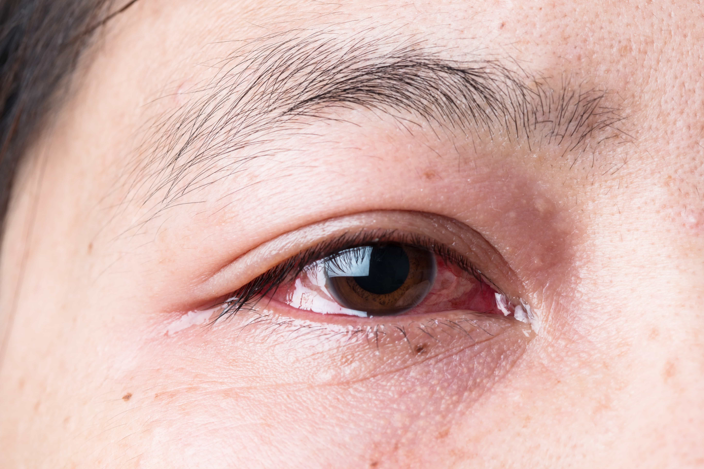 Subconjunctival Hemorrhage (မျက်ကြည်လွှာအောက်တွင်သွေးထွက်ခြင်း )