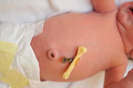 Umbilical Hernia (ááťááşáá
áşáááŻááşáĄá°ááťá˝áśááźááşá¸ )