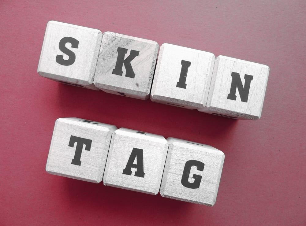 Skin Tags (အသားပို)