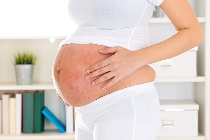 ကိုယ်ဝန်ဆောင်ကာလအတွင်းမှာလည်း Psoriasis ဖြစ်နိုင်ပါတယ်