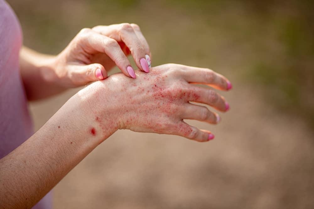 Skin Rash (အရေပြားအကွက်ထခြင်း)
