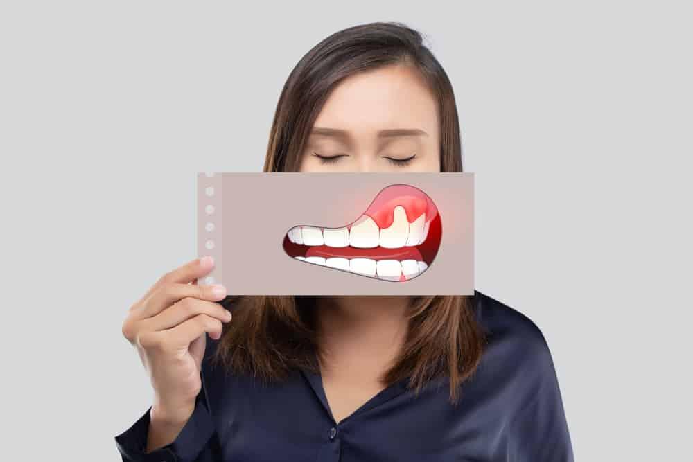 Gingivitis ( သွားဖုံးရောင်ခြင်း ) အကြောင်း