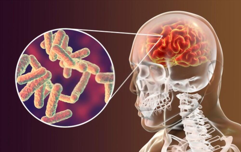 Tuberculosis of meninges and central nervous system ( ဦးနှောက်အာရုံကြောတီဘီ )