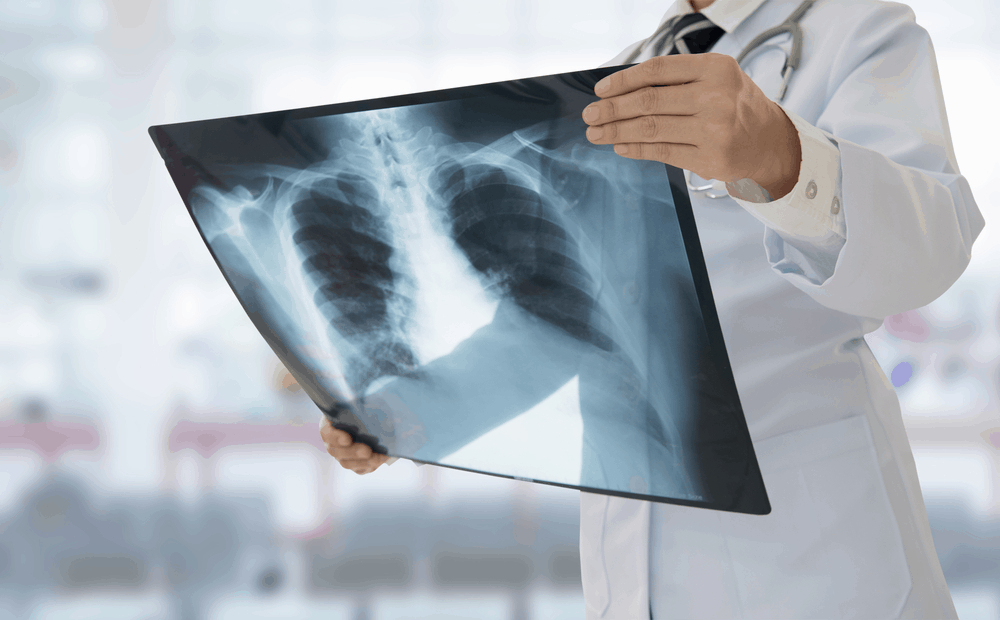 ရင်ဘတ်ဓါတ်မှန် Chest X-ray အကြောင်း သိကောင်းစရာများ ။ ။