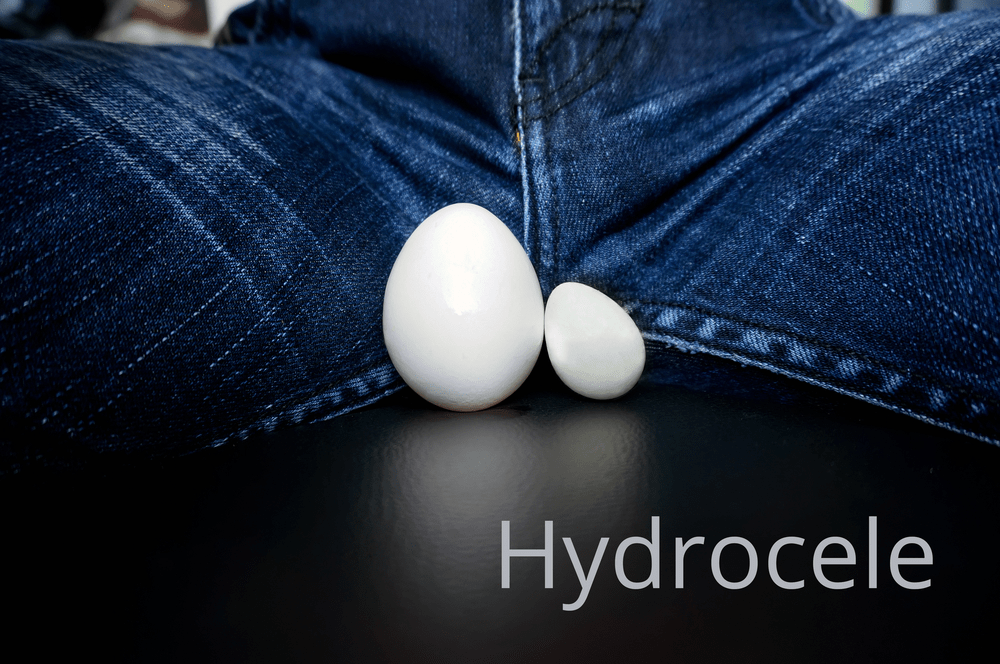 Hydrocele( မုတ္တရောဂါ ) ဝှေးစေ့ပတ်လည်အရည်စုပြီး ကပ္ပယ်အိတ်ကြီးလာတဲ့ ပြဿနာ ။ ။