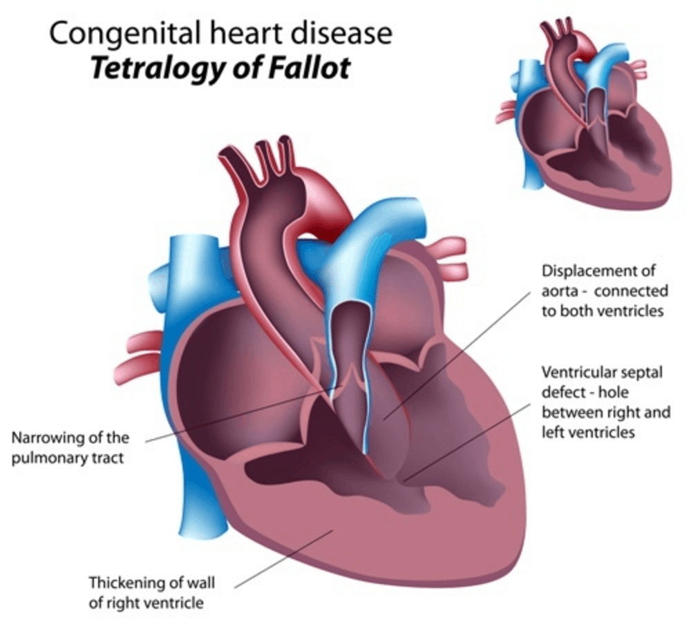 Tetralogy of Fallot မွေးရာပါ ပြာနှမ်းတဲ့နှလုံးရောဂါ ။ ။