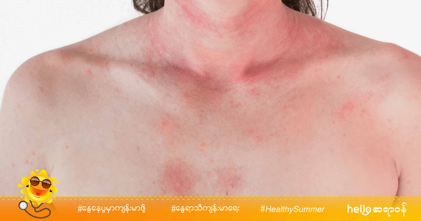 အရေပြားမှာ အင်ပျဉ်ထခဲ့ရင် အသုံးဝင်မယ့်နည်းလမ်းလေးတွေ