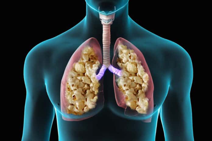 ပေါက်ပေါက်ဆုပ် အဆုတ် (Popcorn lung)