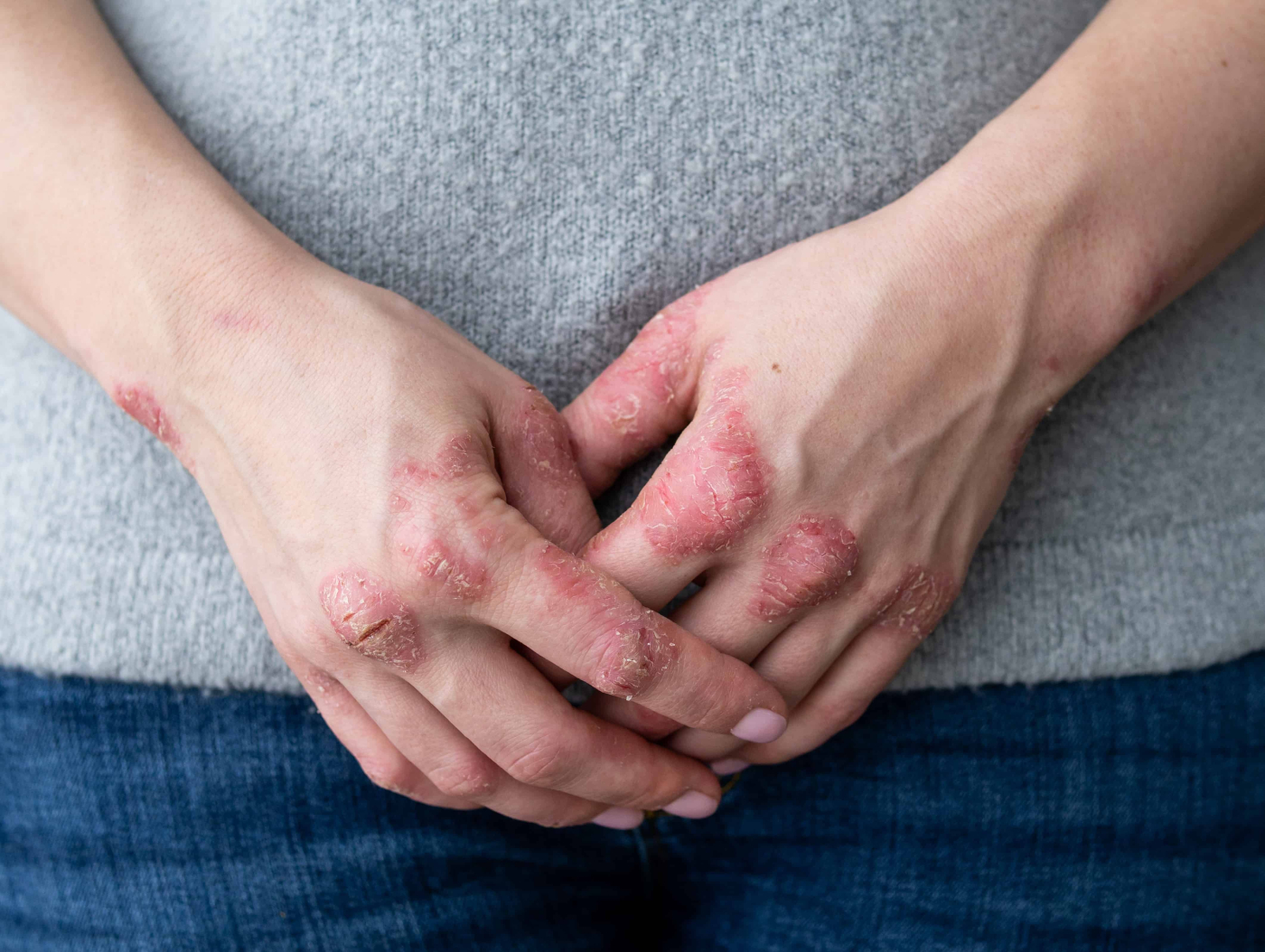 ဆိုရီယေးစစ် (Psoriasis)ပြဿနာအဖြေရှာရအောင်