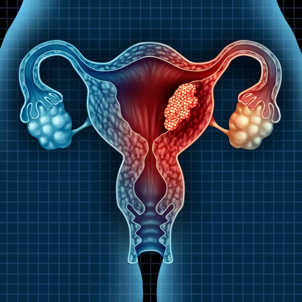 သားအိမ်ကင်ဆာ (Endometrial cancer)