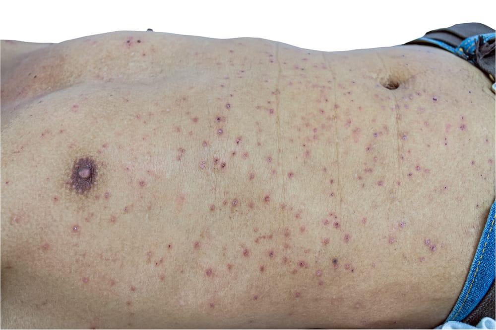 Steven-Johnson syndrome (ပြင်းထန်ဓာတ်မတည့်ရောဂါ)
