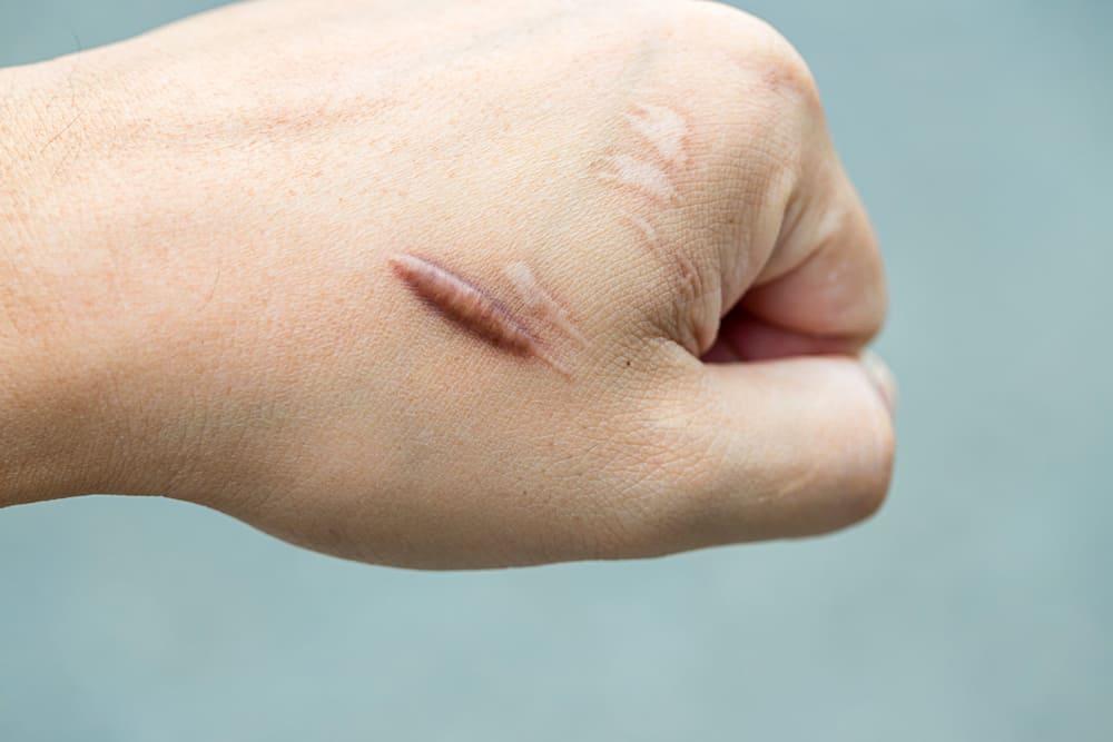 Keloid အမာရွတ်ကို ဘယ်လိုဖယ်ရှားကြမလဲ။