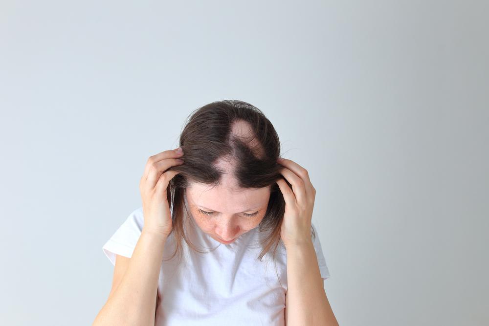 ဆံပင်အကွက်လိုက်ကျွတ် စေတဲ့ Alopecia areata